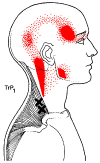 dryneedling